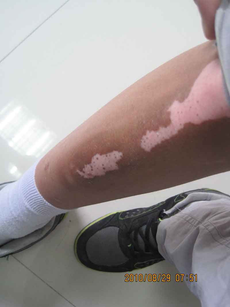 体癣跟白癜风有什么区别