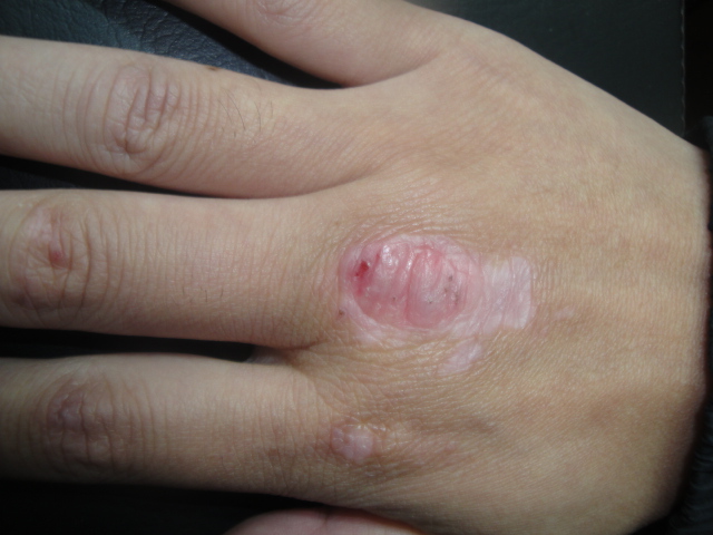 手背有白点是怎么回事