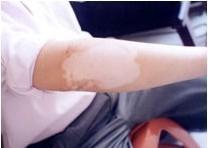 胳膊上有白色斑点是怎么了?是白癜风吗