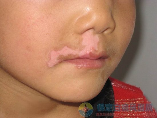 白癜风摩擦后边缘会变红色吗?