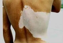 处在进展期的白癜风有什么特点?