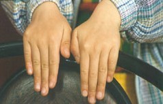 为什么手上容易患白癜风呢?