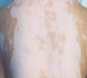 发展期白癜风常见的几种治疗方法有哪些?