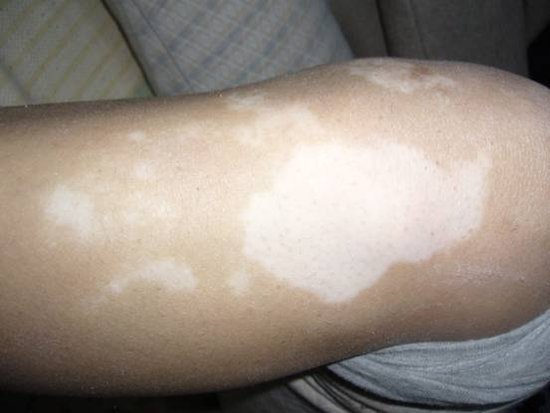 治疗初发期白癜风好的方法是什么?