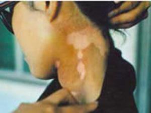 后颈的发展期白癜风用什么方法治疗效果好?