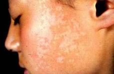 面部白癜风白斑扩散的危害有哪些?