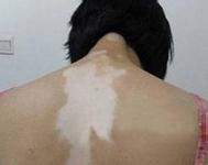 泛发型白癜风在皮肤上出现有什么样的症状?