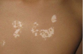 白癜风容易和哪些病相混淆呢