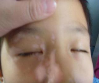 儿童得白癜风的病因有哪些?