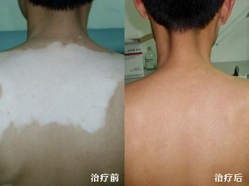 白癜风时间受到哪些因素影响?