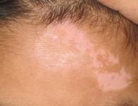 白癜风在伍德灯下是什么颜色?