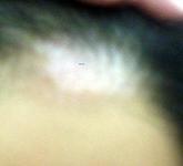 头部白癜风具体都有哪些症状?