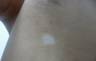 究竟是什么因素使人们患上白癜风