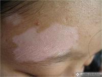 为什么脸上有些地方白斑在恢复有些地方在扩散?