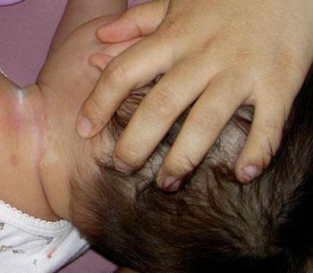 先天性白癜风的形成及表现症状?