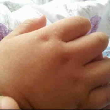 石家庄远大白癜风医院能治疗婴儿白癜风吗?