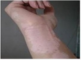 身上长白斑怎么判断是不是白癜风?