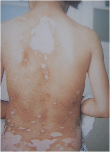 白癜风初期的临床症状有哪些