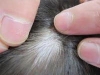 导致白癜风患者患处毛发变白的原因有哪些