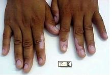 白癜风长在手指上能吗