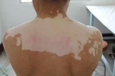 白癜风的后期症状有什么特征?