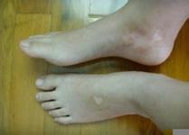 白癜风患者白斑容易长在哪里?