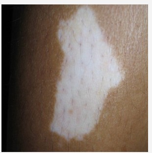 手背上有白痕是白癜风吗？