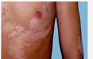 青少年胸部白癜风