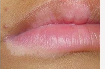 白癜风患者唇角出现小白点可以化妆遮住吗？