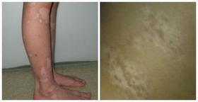 不同类型的白癜风怎么查病因呢?