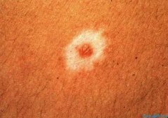 通过什么症状可以区分晕痣和白癜风?