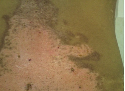 晒伤出现的白斑跟白癜风有什么不同?