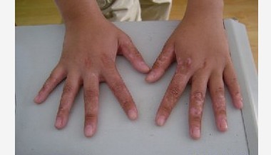 色素异常引起的白癜风该怎么治疗?