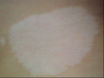 身上有白色斑块跟白癜风有关系吗?