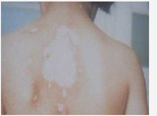 白癜风怎么看是发展期还是稳定期?