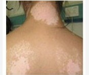 寻常型白癜风该如何预防?