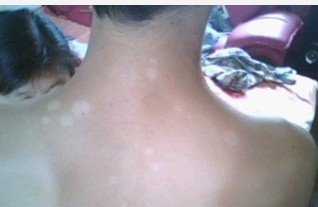 中医学看白癜风是因何而起?