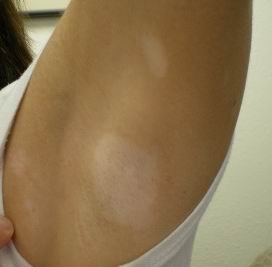 什么样的白斑是完全性白癜风?