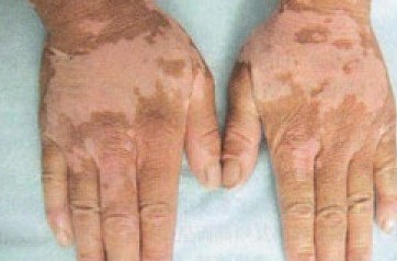 局限性白癜风怎么治疗可以好?