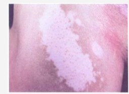 白癜风白斑皮肤摩擦会发红吗?