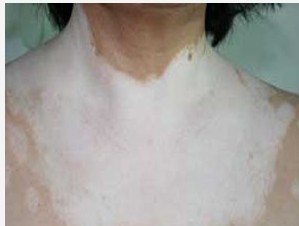 泛发型白癜风发病的前兆有什么?