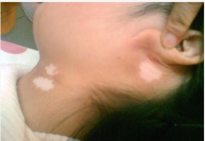 儿童白癜风患者的早期症状是怎么样的