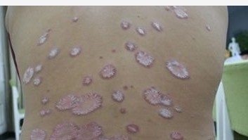 白癜风紫外线光疗起泡是怎么回事?