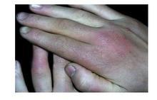 白癜风患者在生活中应注意哪些危害