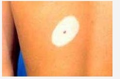 晕痣型白癜风患者该如何治疗?