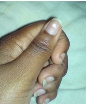 手部长白癜风会导致指甲里也出现白斑吗?(