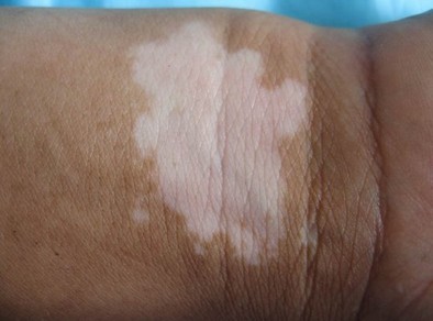 发展期的白癜风有哪些症状表现