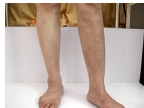 白癜风的危害具体表现在哪些方面