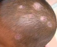 小儿白癜风明显症状有哪些?