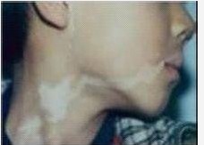 白癜风患者发展期的明显症状有哪些?